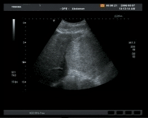 Kontrasmittelsonogrpahie bei unklarem Tumor der Leber